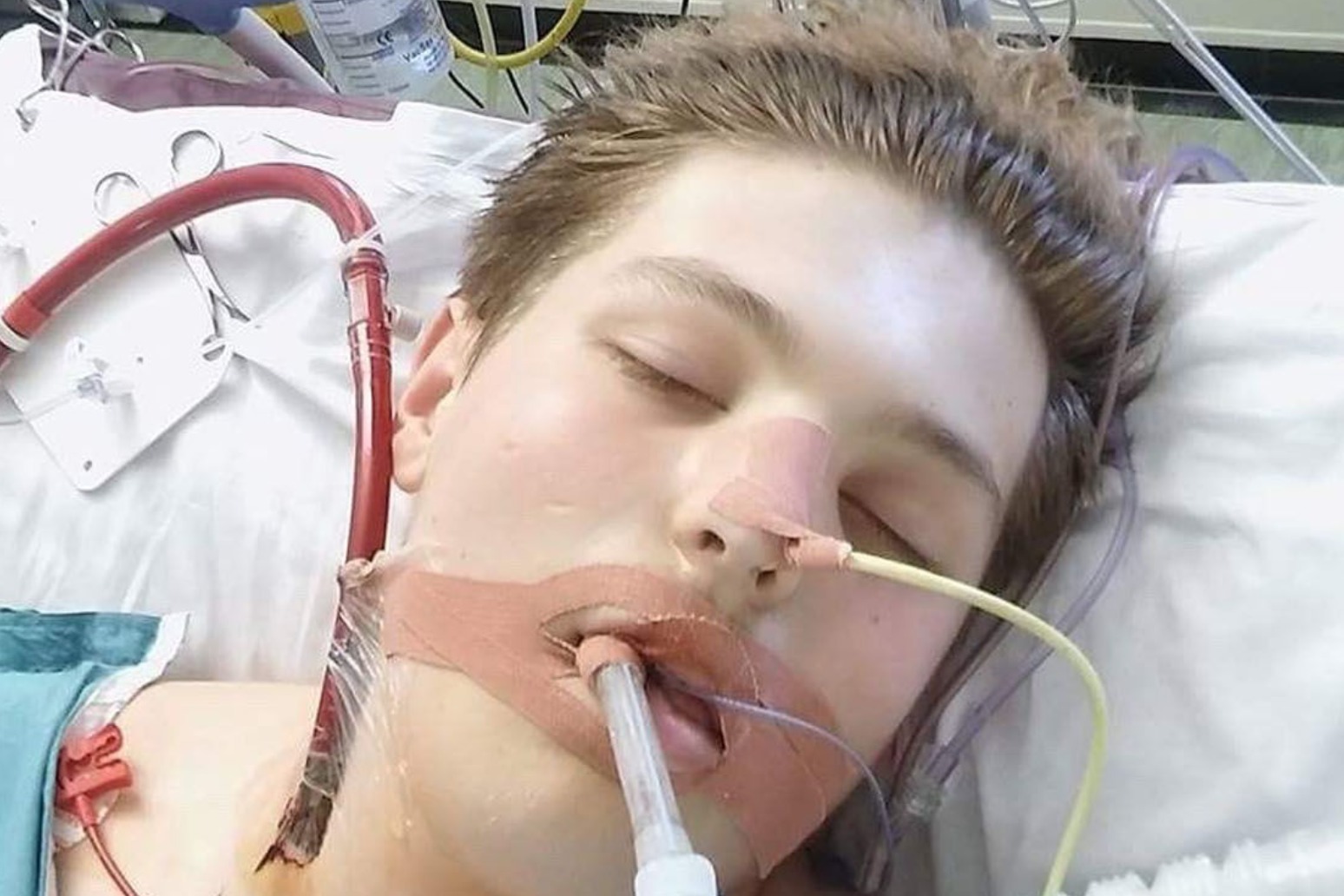 TEENAGER ALMOST DIED FROM LUNG FAILURE AFTER VAPING 